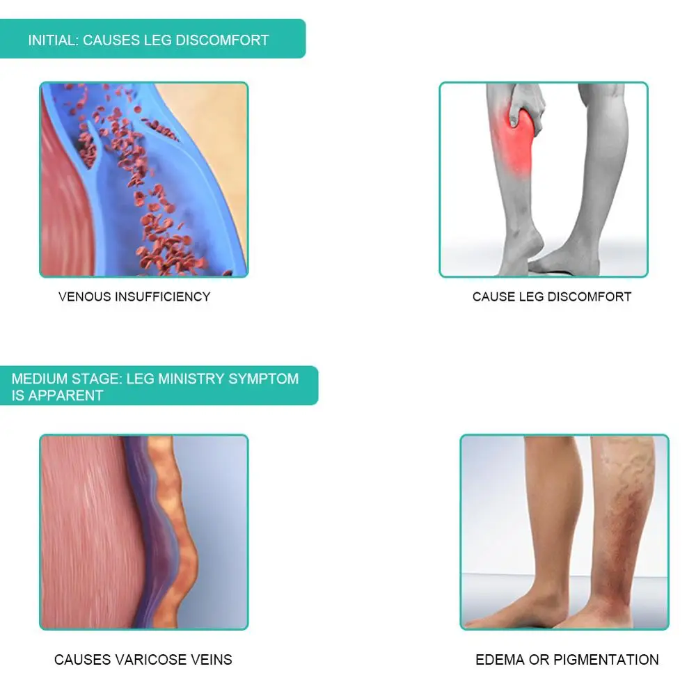 1 Paar Medische Compressie Sok - Compression Calf Sleeve recensie en prijs